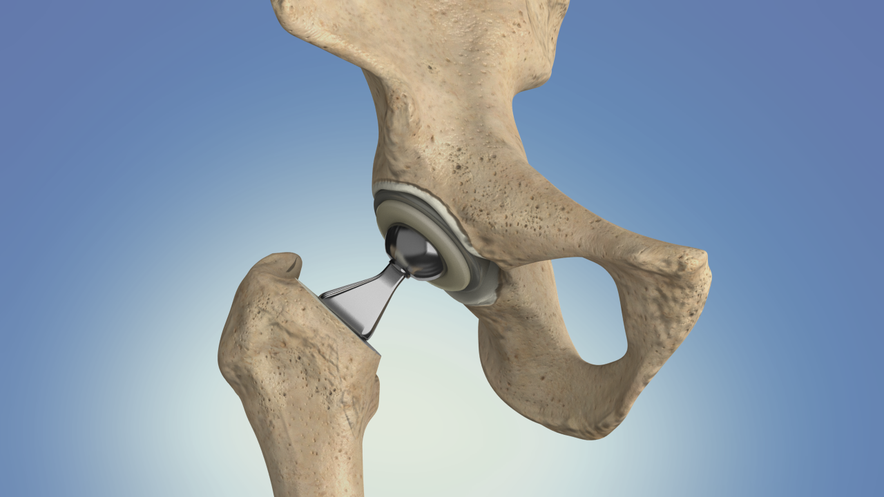 Hip Replacement– Hip3wiz